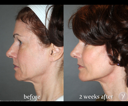The transformation from the initial image with signs of aging to the subsequent image with a more refreshed appearance emphasizes the effectiveness of Y-Lift treatment.