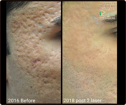 In the initial image, the man's face displays acne scars, but in the subsequent picture, the results of acne treatment are evident, with smoother and clearer skin.