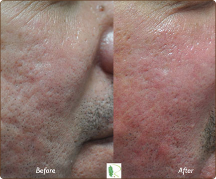 Acne scars marred the man's face initially, but after receiving treatment, his skin appears rejuvenated and acne-free.