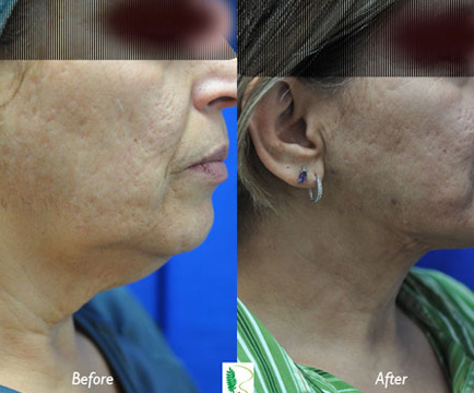 The woman's facial appearance in the before photo reflects the presence of a double chin, but in the after image, the double chin treatment has achieved a more sculpted and defined look.